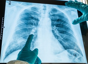 Un estudio detecta que el 40% de las personas ingresadas por covid19 tienen secuelas en su función pulmonar