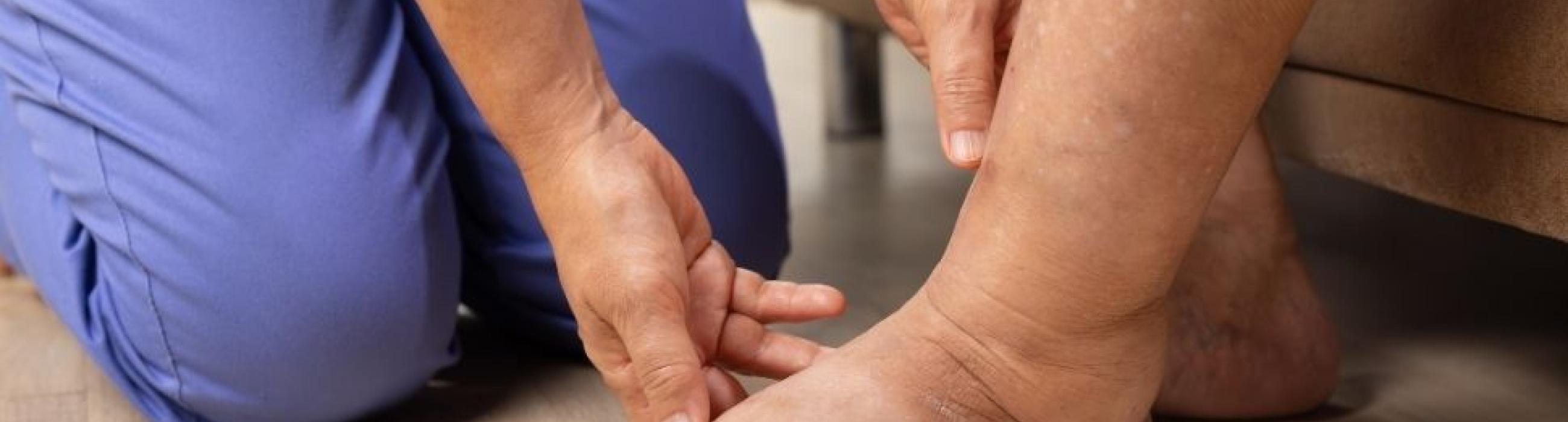 Imatge recurs de limfedema