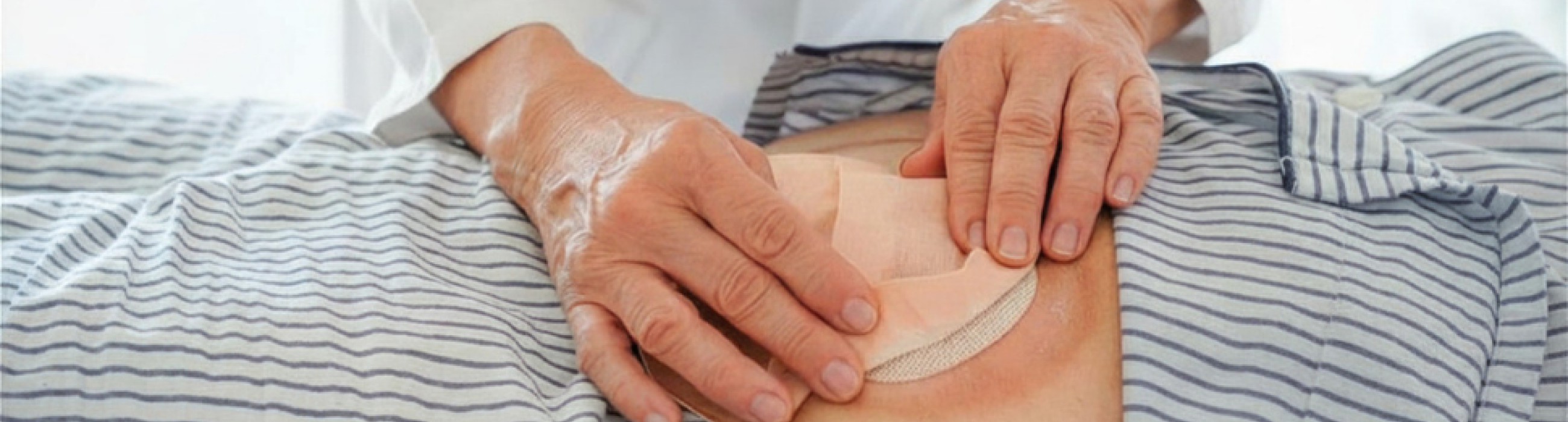 Imatge de recurs d'ostomies