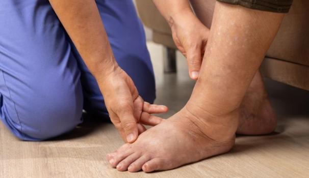 Imatge recurs de limfedema